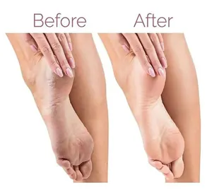 Electric Pedi callus remover
